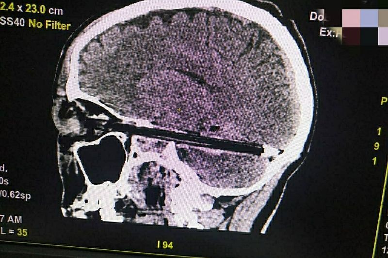 Врачи спасли пациента с шариковой ручкой в мозгу