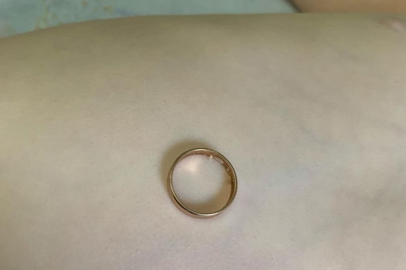 Врачи достали кольцо из желудка двухлетней девочки в Туапсе 