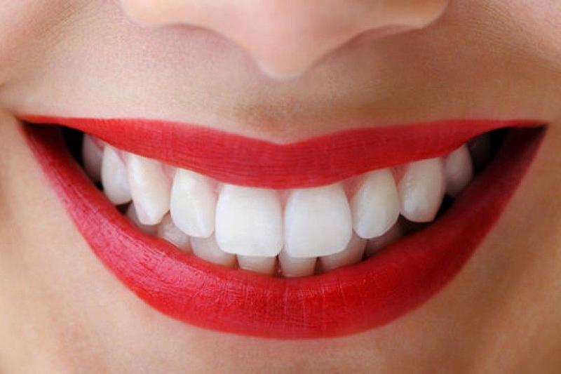 Химики рассказали об опасности отбеливания зубов
