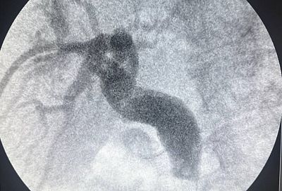 Врачи в Краснодаре избавили пациента от крупного камня в желчном протоке через прокол со стороны печени