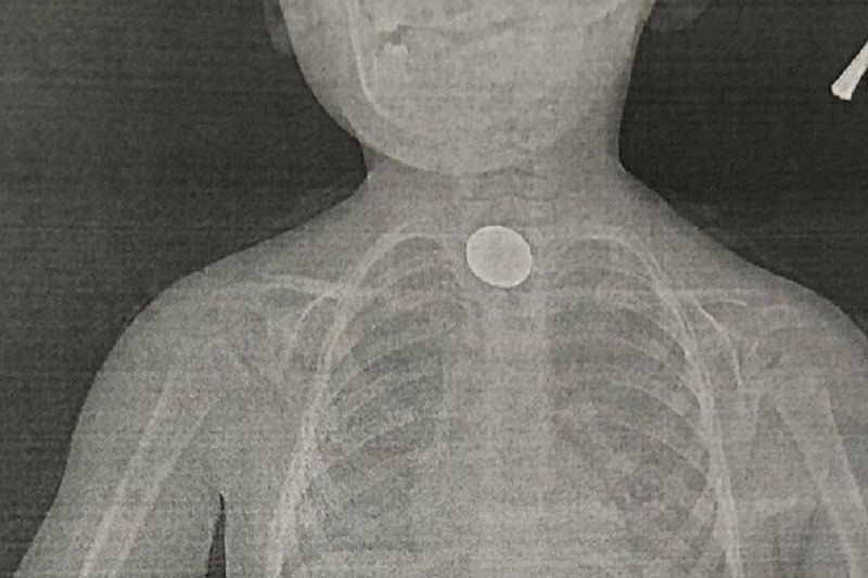 В Новороссийске врачи достали монету из пищевода 3-летнего мальчика