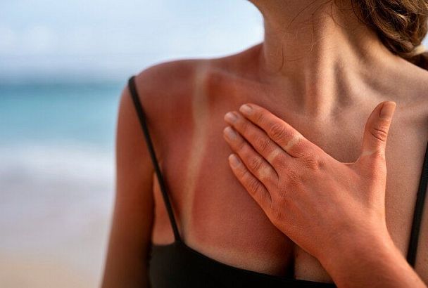 Дерматолог Николаева предупреждает: чем не стоит лечить солнечный ожог на коже