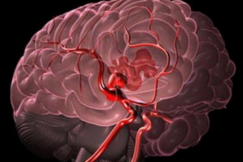Ученые создали нейросеть, выявляющую кровоизлияния в мозг лучше врачей
