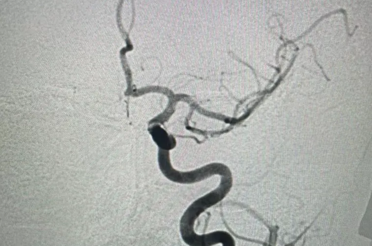 Ювелирная операция: врачи Новороссийска спасли пациентку, удалив тромб ...