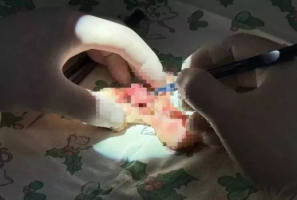 Из больницы в Краснодаре выписали 4-летнего мальчика, которому пришили откушенное собакой лицо